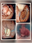 4. POLIPECTOMIA CON ENDOLAZO