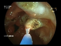 7. ACABANDO CON LA ANEMIA
