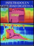 24. INFILTRADOS EN MOTILIDAD DIGESTIVA