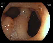 32. COLUMNA EN LA CUEVA DUDENAL 'GRAN ÚLCERA'