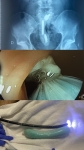 2. CUERPO EXTRAÑO RECTAL: RESOLUCIÓN POR VÍA ENDOSCÓPICA BAJA