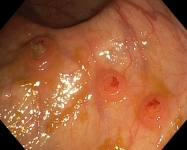 3. METASTASIS PULMONARES EN EL COLON