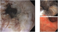 4. LESION POR INGESTA DE SALFUMAN Y MEJORA TRAS TRATAMIENTO